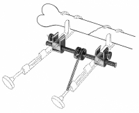 Gerster Traction Bar